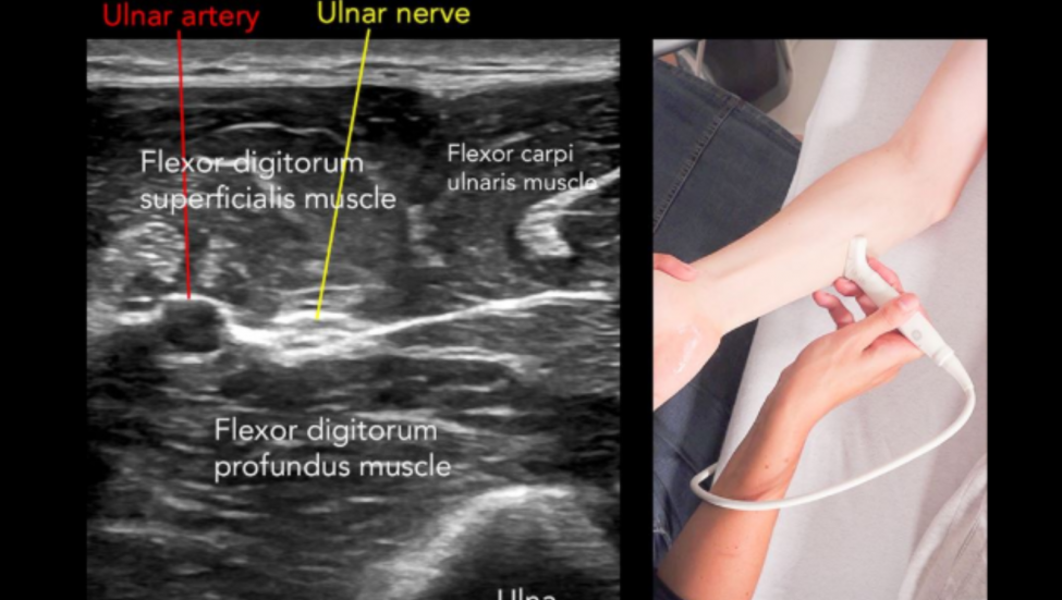 Basic Nerve Ultrasound Course Online Sonocampus 7790